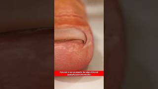 S.307||Painful Ingrow Toe Nail||#shorts,#shortvideo,#healthtips,#drmohofilmondal..
