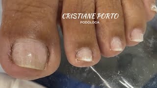 🤤| VEJA QUE LIMPEZA SATISFATÓRIA ! #podologia #satisfatorio #unhas 