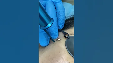 ازالة الشامات بطريقة سهلة مع الليزر Mole Removal 