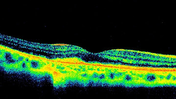 Choroidal Neovascularization