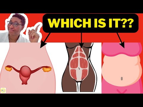 Causes Of Big Stomach In A Woman - Fibroids | Diastasis Recti | Belly Fat?