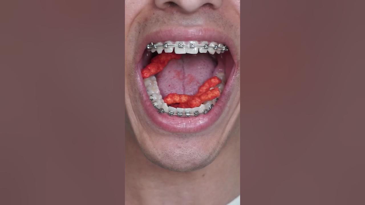 FLAMIN’ Hot Cheetos vs Braces 🥵 braces YouTube