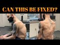 SEVERE Scoliosis + Kyphosis & Chiropractic. Former Power Lifter Suffers Career Ending Injury.