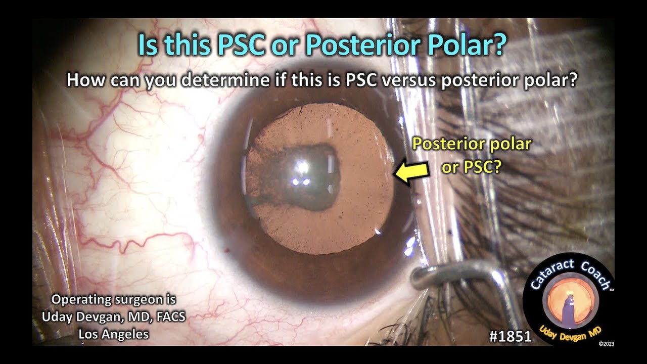 CataractCoach™ 1851 posterior sub capsular or posterior polar cataract