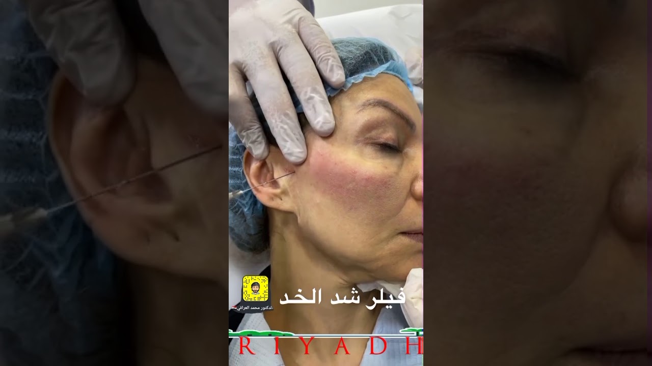 فيلر خدود بتقنيه الشد مع د محمد العراقي