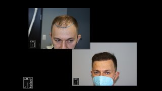 Before and After Photos of FUE Hair Transplant with 2,550 Grafts  at Chicago Hair Transplant Clinic