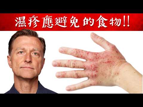 濕疹,不要吃的食物,自然療法,柏格醫生 Dr Berg