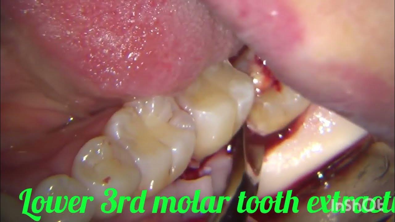 lower 3rd molar tooth extraction YouTube