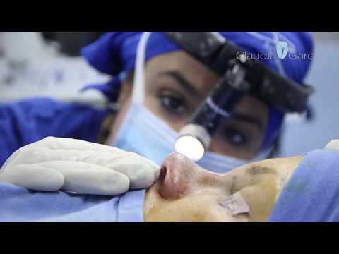 Excelente Cirugía Rinoplastia Primaria con la Dra. Claudia García