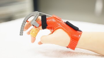 Isoforce Outrigger Static Progressive Orthosis Fabrication with Thermoplastic Sheet Material