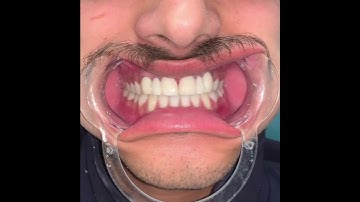 Cosmetic Correction of missing lateral Incisors ✅✌️