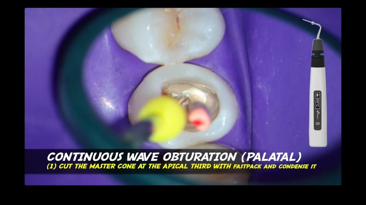 continuous wave endodontic obturation warm vertical compaction fastfill