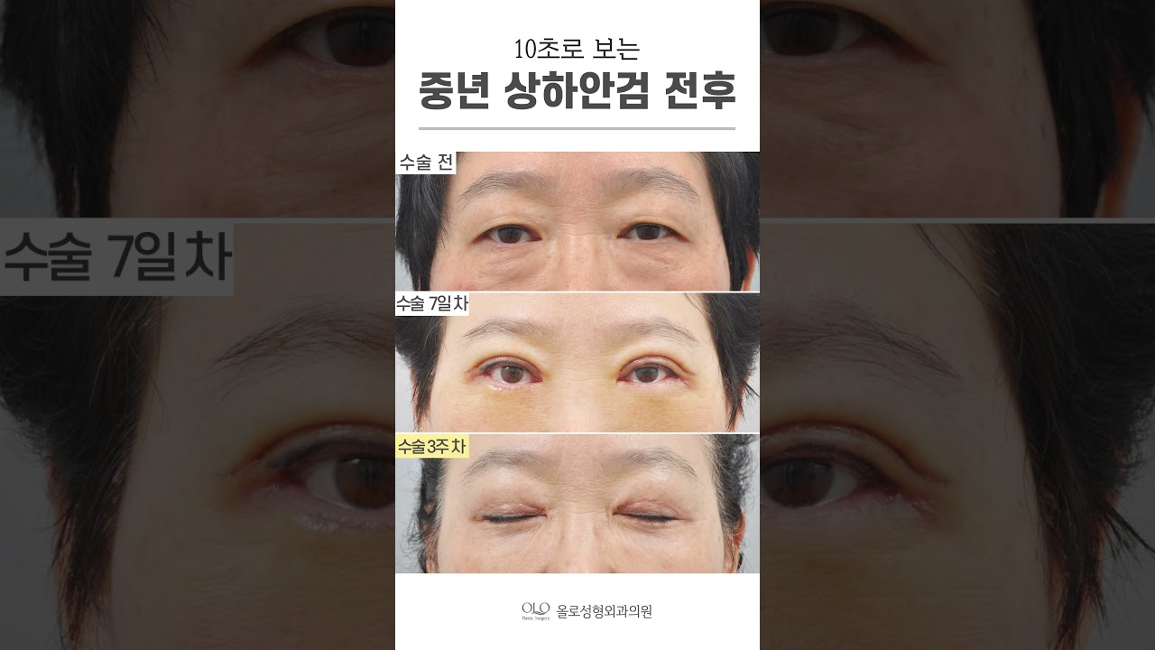 [Bệnh viện phẫu thuật thẩm mỹ OLO] #phẫu_thuật_mắt_tuổi_trung_niên có thể giải quyết được như thế này sao? Không còn vẻ ngoài chảy xệ, mệt mỏi! Chức năng là ưu tiên hàng đầu! Cùng chăm sóc cả vẻ đẹp nhé! #bí_quyết_trẻ_lại #phẫu_thuật_thẩm_mỹ_OLO_gần_bạn #shorts #easy #really