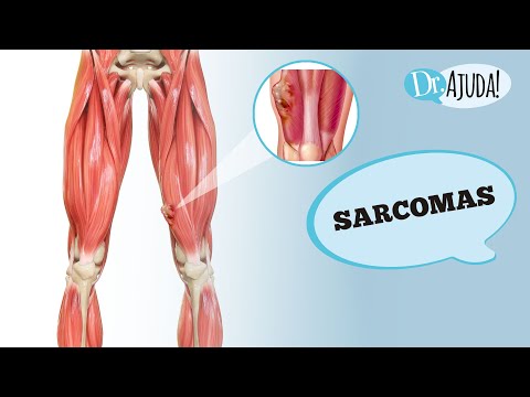 Vídeo: Qual classificação do sarcoma pleomórfico indiferenciado?