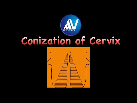 Video: Electroconization Of The Cervix With Dysplasia: Types, Stages And Complications