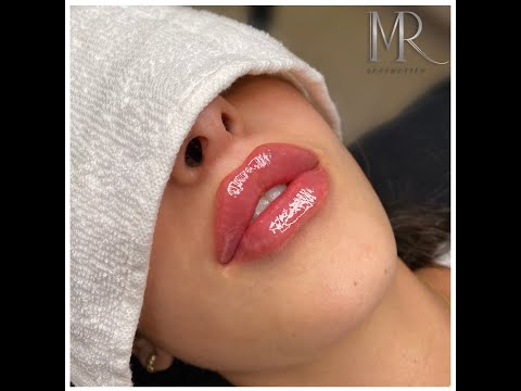 ד"ר משה רוזן עיצוב שפתיים בעזרת חומצה היאלורונית