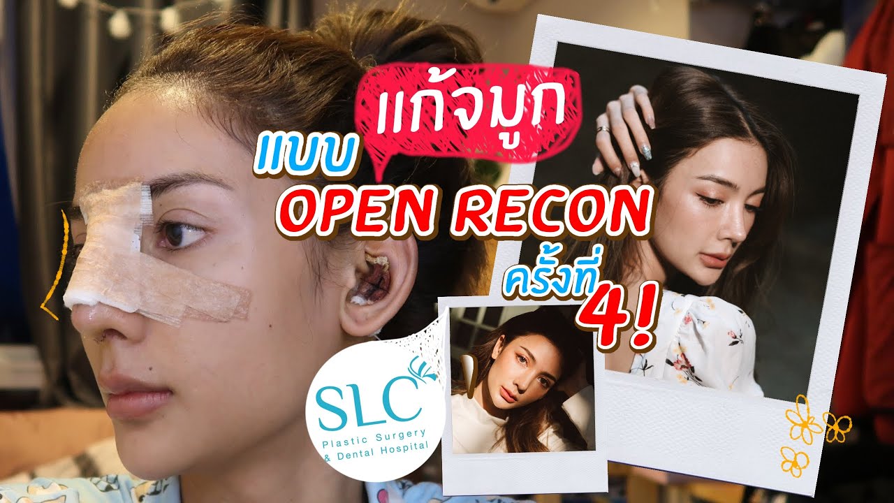 ทําจมูกที่ไหนดี  2022 Update  รีวิวแก้จมูกแบบ Open Recon รอบที่ 4 หน้าหวานขึ้นมากก!! North North Channel