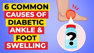 The 6 Most Common Causes Of Foot & Ankle Swelling + 6 Amazing Remedies To Fix It!