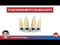 Posicionamiento de Brackets