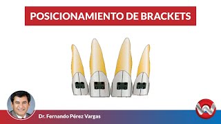 Posicionamiento de Brackets