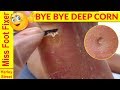 SATISFYING DEEP CALLUS AND CORN REMOVAL BY MISS FOOT FIXER PART 2