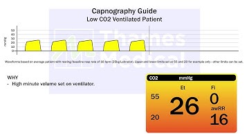 Capnography Waveforms: Low CO2 (Ventilated Patient)
