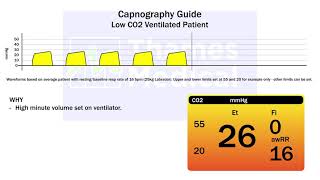 Capnography Waveforms: Low CO2 (Ventilated Patient)