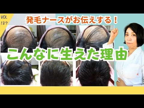 ミノキシジルやフィナステリドを飲んでも生えなかったAGA薄毛治療の理由とは?