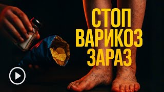 Варикоз і набряки: 6 звичок, що нищать судини зараз