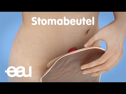 Video: Wie oft Stomabeutel wechseln?