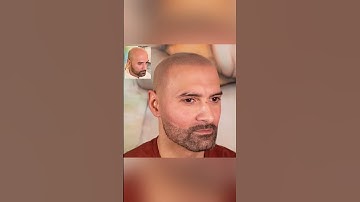 Would you believe this is a HAIR TATTOO❓ #shorts #scalpmicropigmentation #micropigmentation #smp