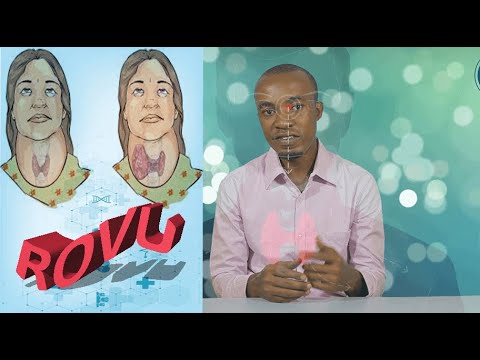 ROVU|GOITRE:Dalili,Sababu,Matibabu