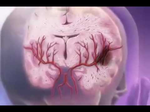 Đột quỵ - youtube