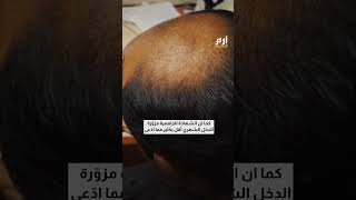 "باروكة تقود للمحكمة".. امرأة تقاضي زوجها بعد اكتشاف صلعه