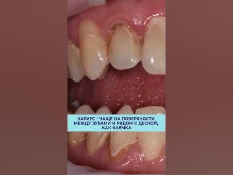 БЕЛЫЕ ЗУБЫ - ЭТО ПРИЗНАК КАРИЕСА! #зубы #стоматология #кариес - YouTube