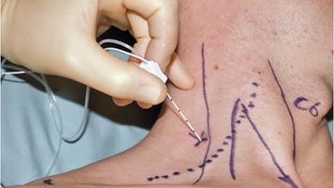 Interscalene anatomy