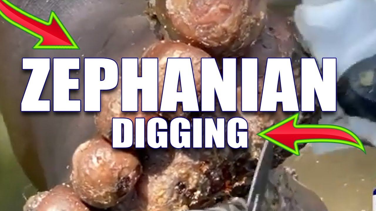 Jigger Digging Zephaniah's Left Foot YouTube