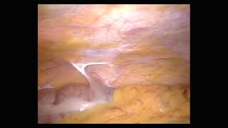 腹腔鏡下胆嚢摘出 (ノーカット版) laparoscopic cholecystectomy