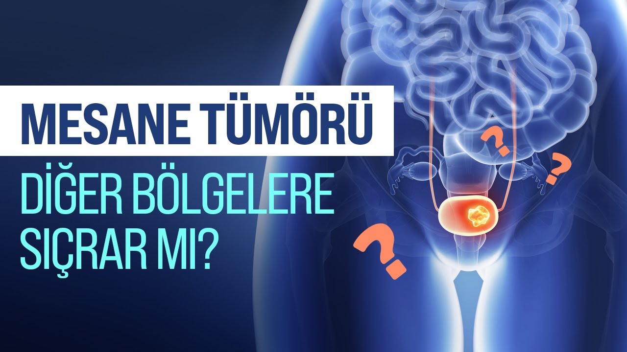 Mesane Kanserinin Çeşitleri Nelerdir? Mesane Tümörü Diğer Bölgelere Sıçrar Mı?