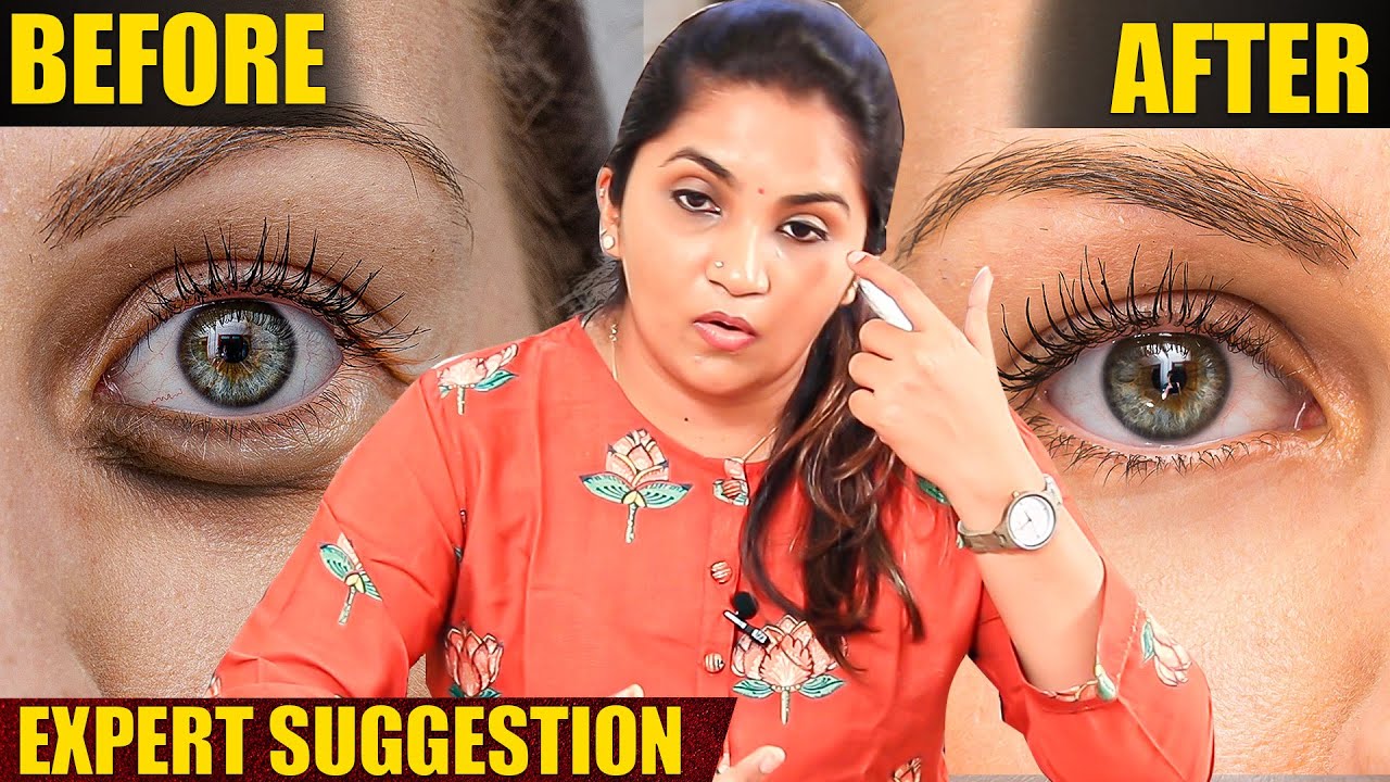 Eye Bags Surgery பண்ண......! | Expert Dr.S.Krithika Ravindran Opensup ...