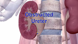 Surgical Techniques Of Laparoscopic Pyloplasty By Dr P P Singh