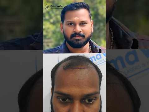 Beard Transplant Results and Recovery Guide