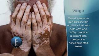 Vitiligo