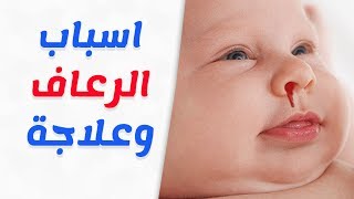 الاسعافات الاولية وطرق العلاج لنزيف الانف والرعاف عند الاطفال