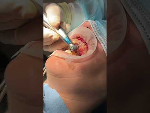 Cirugía guiada con regeneración ósea. #cirugia #dentista #dentist
