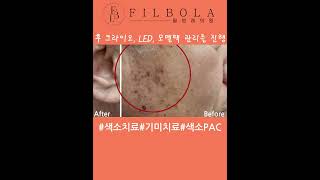 #색소시술 #기미치료 #주근깨 #흑자 #잡티 #색소치료 #유성구피부과 #레이저치료 #스킨컨디션 #색소스타트패키지