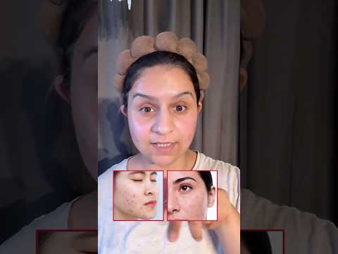 DIY Facial for Acne-Prone Skin 🌿 | Easy Home Facial for Pimples & Fresh Skin