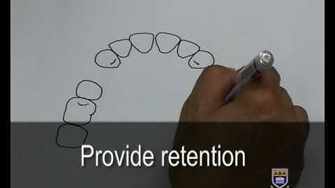 Designing an Upper Metal Partial Denture Kennedy Class III