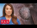 Patient Has a Spongy Bump on Her Head | Dr. Pimple Popper