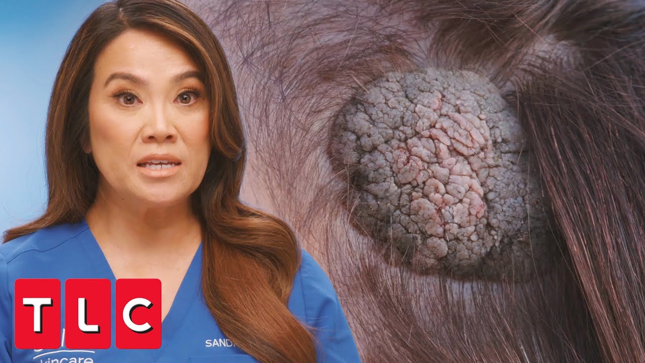 a Spongy Bump on Her Head | Dr. Pimple Popper - YouTube